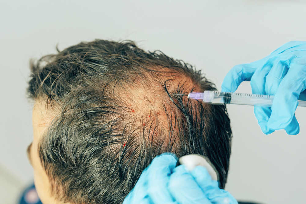 PRP-Therapie gegen Haarausfall am Hinterkopf. 