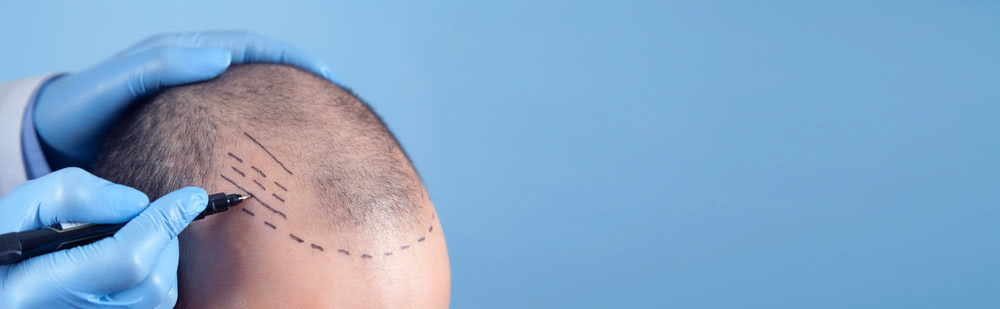 Haarlinie bei einer Haartransplantation