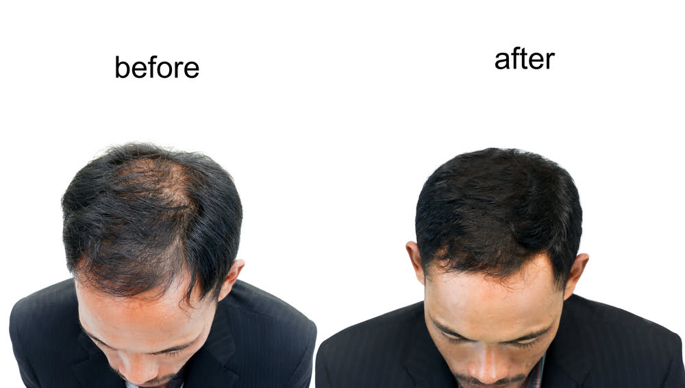 Haartransplantation Vorher-Nachher-Vergleich