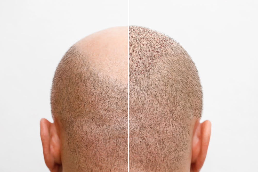 Haartransplantation: Neue Haare, aber bitte mit Stil